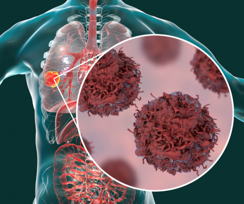 Cancer Screening Day at Seaway Valley CHC on Feb. 3 | SDG Counties